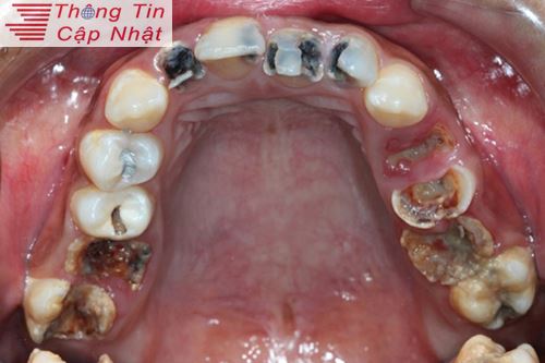 Cách điều trị sưng nướu răng do bệnh viêm lợi chảy máu chân răng ở trẻ em