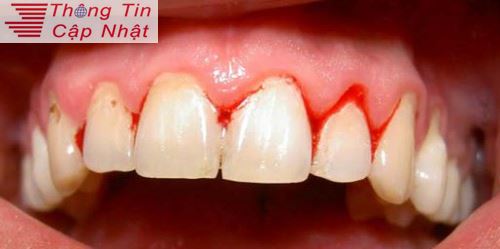 Cách chữa khi bị sưng lợi chảy máu chân răng do viêm nướu răng 2