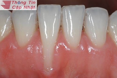 Cách điều trị sưng nướu răng do bệnh viêm lợi viêm tủy răng ở trẻ em