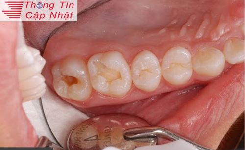 Điều trị tụt lợi tại nhà khi bị viêm lợi sưng nướu răng trong cùng ra sao