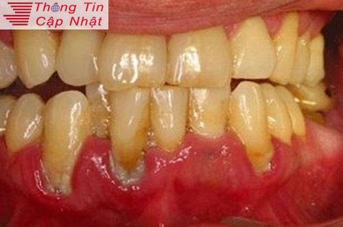 Thuốc trị viêm lợi răng cho bé bị sưng lợi răng hàm
