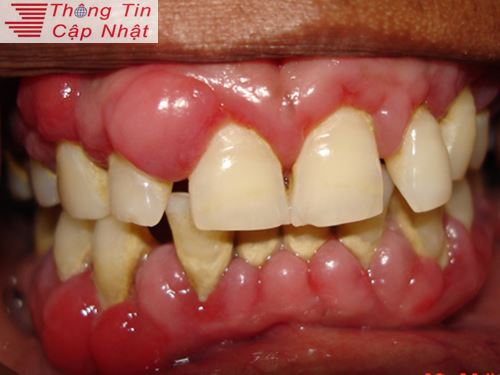 Khi bị viêm lợi đau răng hàm viêm chân răng nên dùng thuốc nam hay thuốc tây
