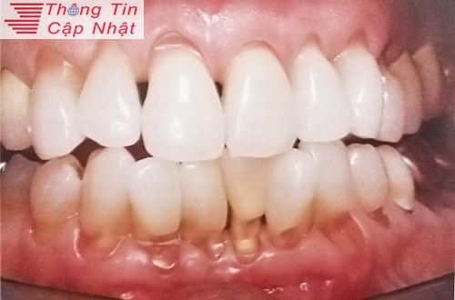 Nướu răng bị sưng và có mủ cách trị viêm lợi viêm nha chu như thế nào
