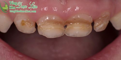 Nướu răng bị sưng và có mủ cách trị viêm lợi tụt lợi như thế nào