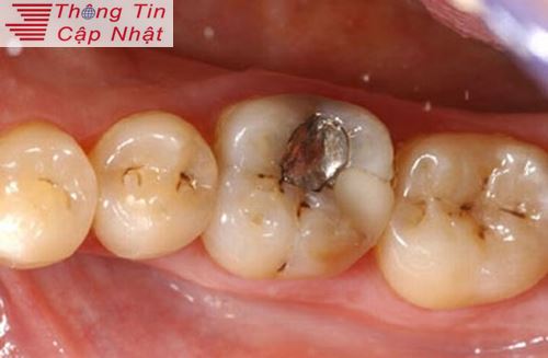 Tại sao khi chữa sâu răng viêm tủy răng khỏi lại bị đau nhức tái phát 2
