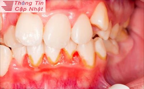 Cách chữa đau sưng nướu răng trong cùng do bệnh viêm lợi viêm tủy răng