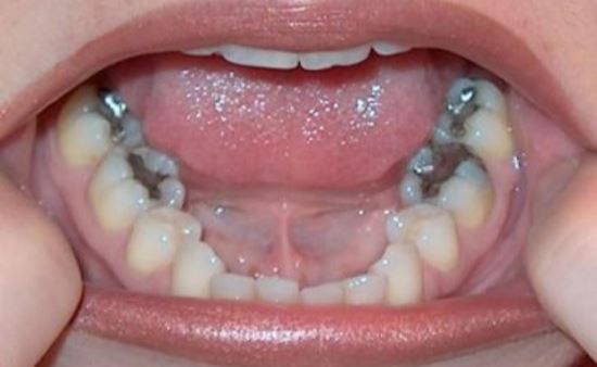 tránh viêm tủy do sâu răng viêm nướu răng hàm nặng