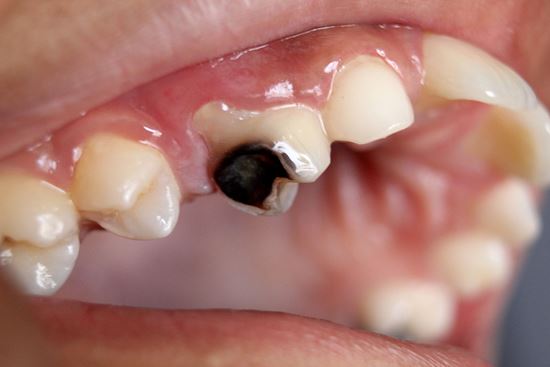 cách trị bệnh sâu răng tụt lợi gây đau nhức răng tại nhà