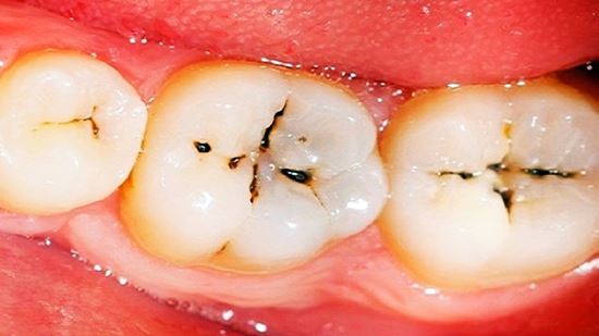 đánh răng nhẹ nhàng với cách trị đau răng tại nhà