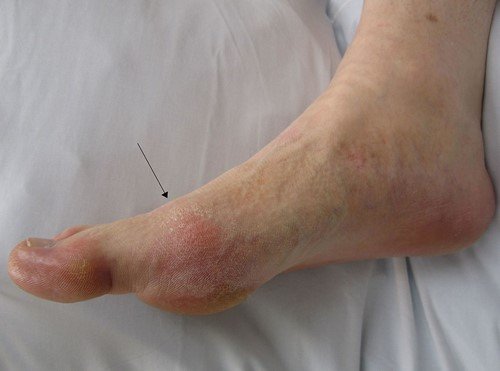 Cách chữa đau khớp gối sai khớp cổ chân bị dãn dây chằng lưng bằng thuốc giảm đau dây thần kinh