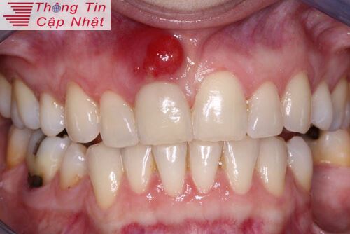 Nguyên nhân nướu răng bị sưng cách chữa viêm lợi đau răng hàm tại nhà