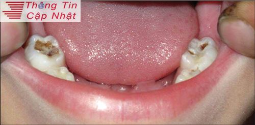 Cách trị sưng nướu đau răng khi bị viêm lợi viêm tủy răng hiệu quả