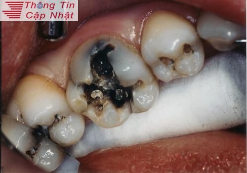 Cách chữa viêm lợi nhức răng đơn giản khi bị sưng nướu răng