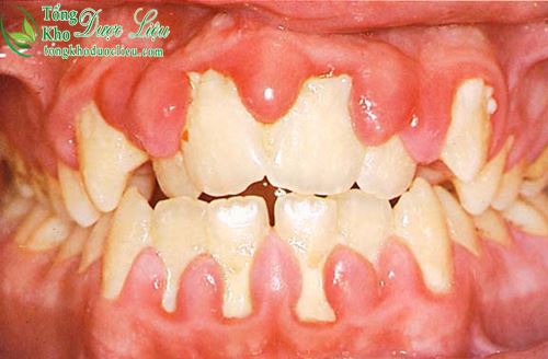 Nguyên nhân nướu răng bị sưng cách chữa viêm lợi sâu răng tại nhà
