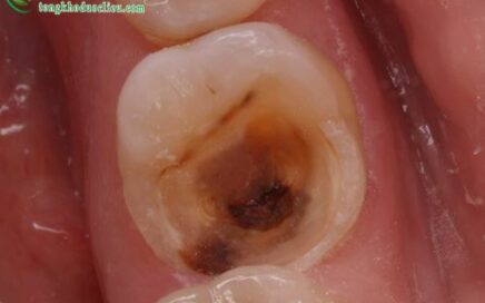 Những kiến thức về bệnh sâu răng và đau nhức răng cần biết 2