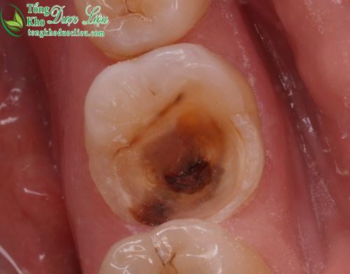 Cách điều trị sưng nướu răng do bệnh viêm lợi sâu răng ở trẻ em