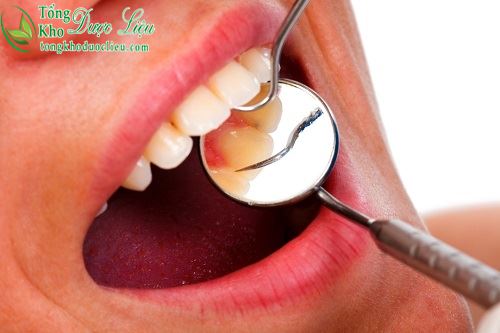 Sử dụng thuốc chữa viêm lợi nhức răng hôi miệng kết hợp điều trị dứt điểm 1
