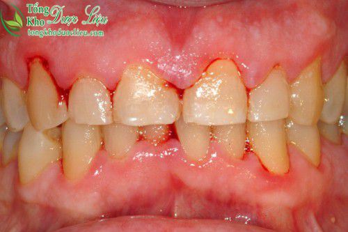Nguyên nhân nướu răng bị sưng cách chữa viêm lợi viêm chân răng tại nhà