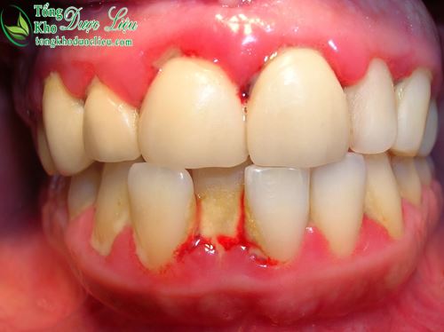 Thuốc đặc trị viêm nướu răng có mủ bằng phương pháp dân gian