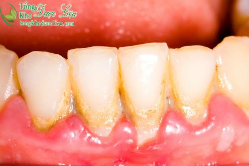 bác sĩ tư vấn cách chữa viêm lợi viêm tủy răng sưng nướu răng trong cùng bằng thuốc 1