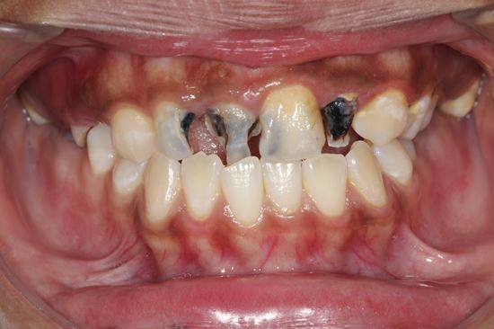 phương pháp chữa sâu răng viêm nướu răng bằng thuốc đặc trị