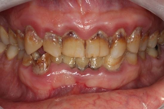 viêm tủy răng cách chữa đau răng nhanh nhất tại nhà