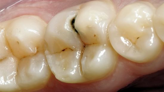 cách trị sâu răng viêm tủy răng bằng tỏi