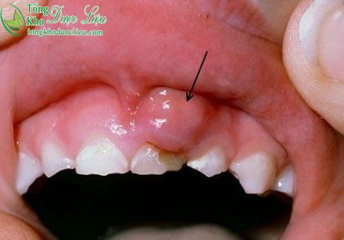 Cách trị viêm nướu răng với trẻ bị viêm lợi đau nhức răng đang mọc răng
