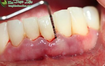 tiết lộ cách trị sưng nướu răng có mủ mãn tính cực hiệu quả